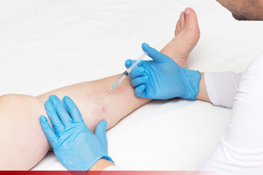 Por que tratar Vasinhos e Varizes com Angiologista e/ou Cirurgião Vascular?